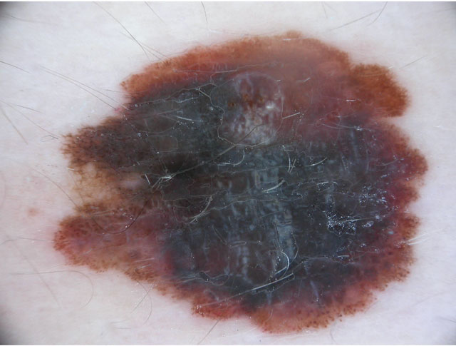 Melanoma