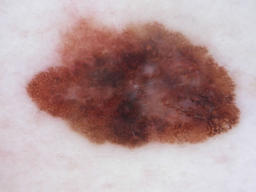 Melanoma