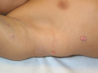 moluscos contagiosos