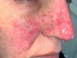 Rosacea