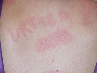 Urticaria